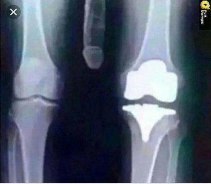 Just Got An X-Ray After My Knee Replacement. Doc Says Everything Looks Good!